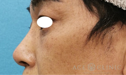 隆鼻術_プロテーゼ,軟骨移植