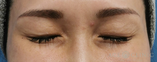 目尻ボトックス注射-【エースクリニック】名古屋院・大阪梅田院