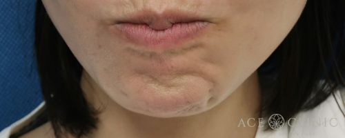 あご梅干しシワボトックス注射-【エースクリニック】名古屋院・大阪梅田院