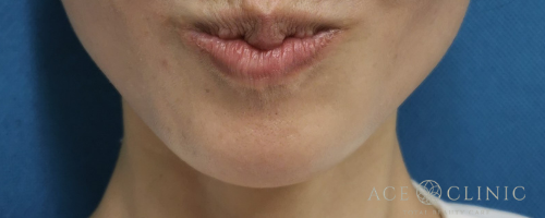 あご梅干しシワボトックス注射-【エースクリニック】名古屋院・大阪梅田院