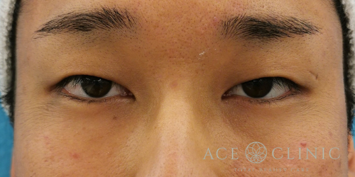 二重まぶた埋没法　症例　20代男性　施術前　【エースクリニック】名古屋・大阪梅田
