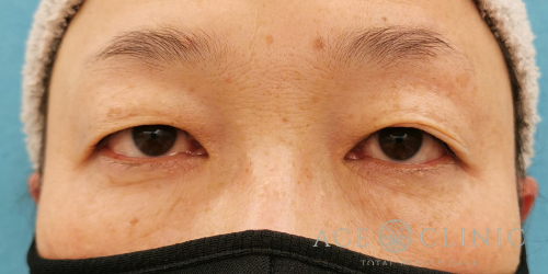 眼瞼下垂治療_名古屋・大阪梅田エースクリニック