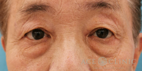 眼瞼下垂・重瞼ライン切開_名古屋・大阪梅田エースクリニック