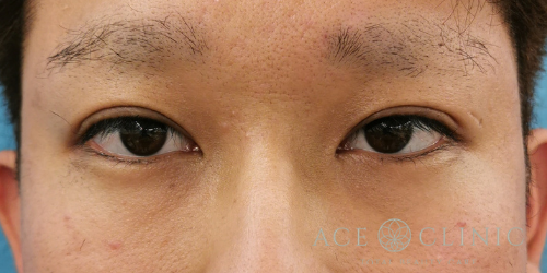 二重まぶた埋没法　症例　20代男性　施術後　【エースクリニック】名古屋・大阪梅田