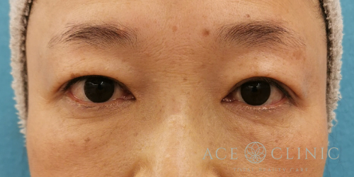 眼瞼下垂治療_名古屋・大阪梅田エースクリニック