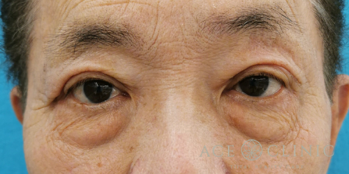 眼瞼下垂・重瞼ライン切開_名古屋・大阪梅田エースクリニック