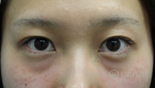 二重まぶた埋没法 症例 30代女性 施術前 【エースクリニック】名古屋・大阪梅田