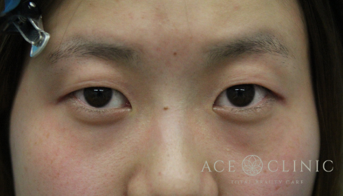 二重瞼全切開法_【エースクリニック】名古屋院・大阪梅田院