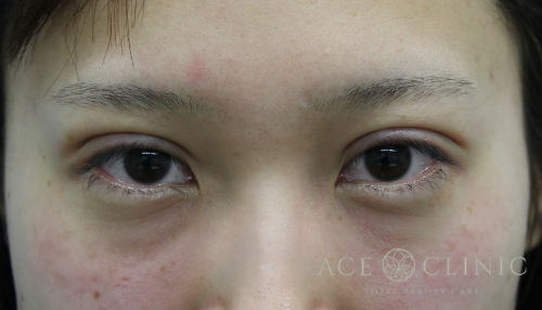 二重まぶた埋没法　症例　30代女性　施術直後　【エースクリニック】名古屋・大阪梅田