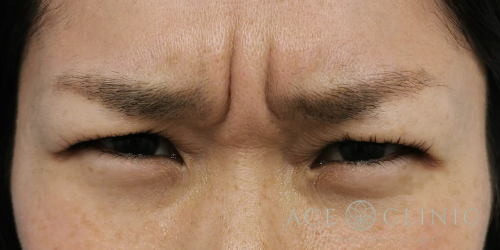 しわ取りボトックス注射_症例_エースクリニック名古屋 (5)