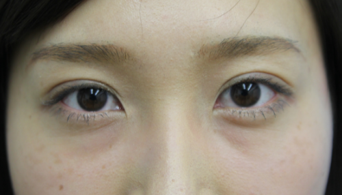 二重まぶた埋没法 症例 30代女性 施術後 【エースクリニック】名古屋・大阪梅田