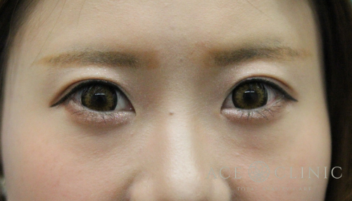 二重瞼全切開法_【エースクリニック】名古屋院・大阪梅田院