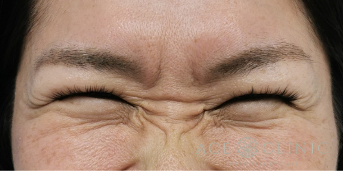 しわ取りボトックス注射_症例_エースクリニック名古屋 (5)