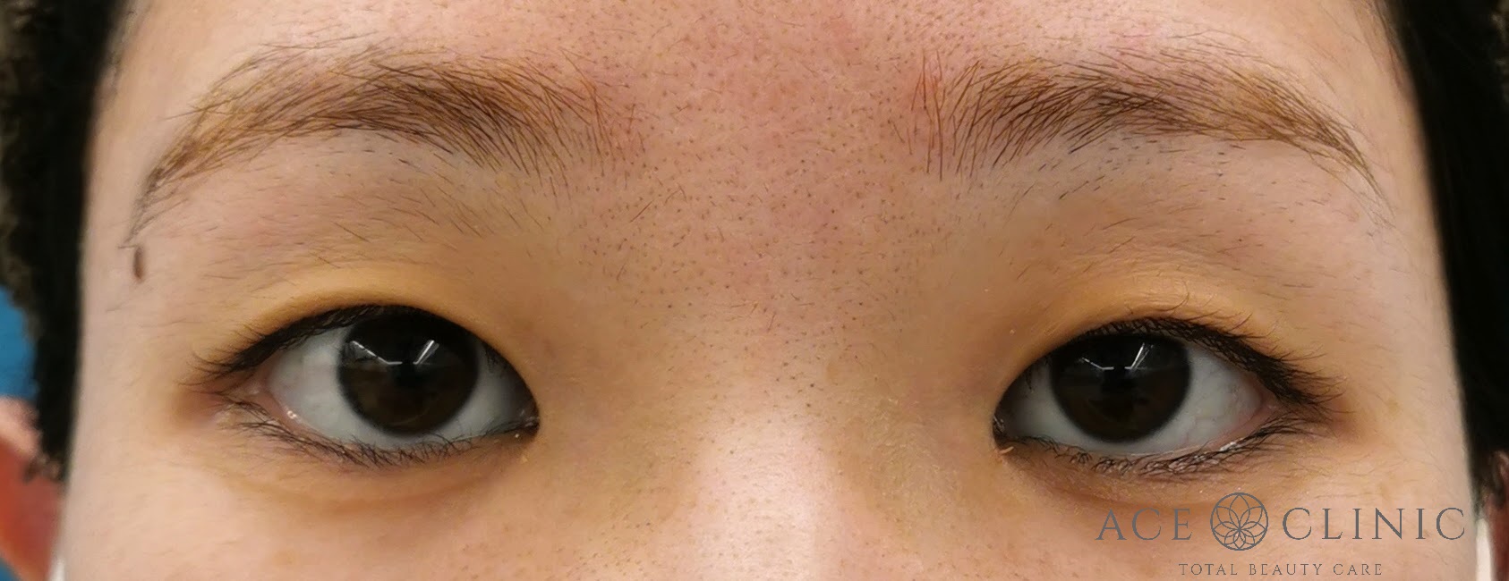 二重まぶた埋没法 症例 20代女性 施術前 【エースクリニック】名古屋・大阪梅田