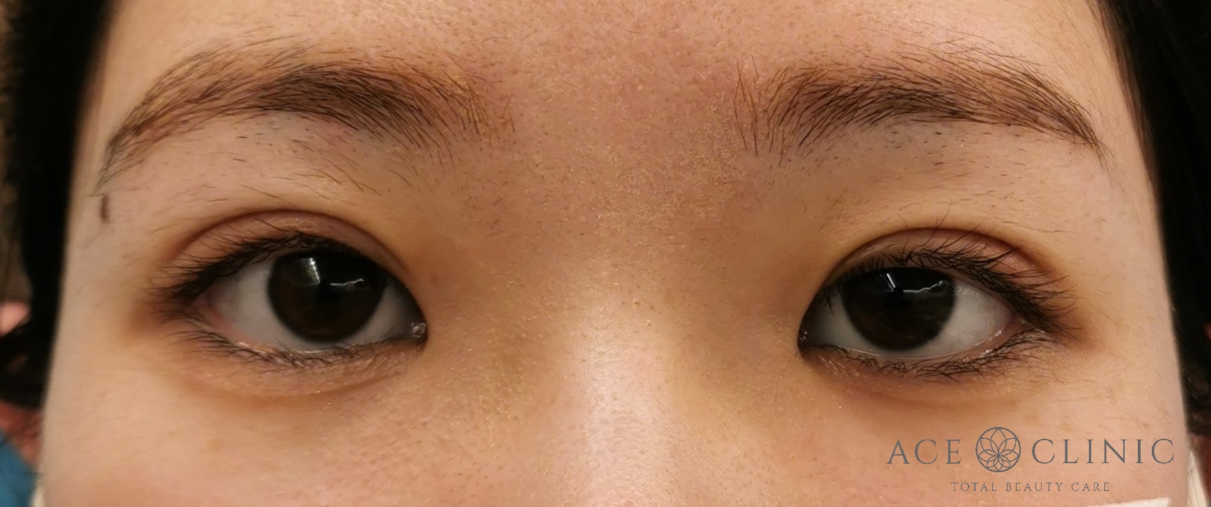 二重まぶた埋没法 症例 20代女性 施術後 【エースクリニック】名古屋・大阪梅田