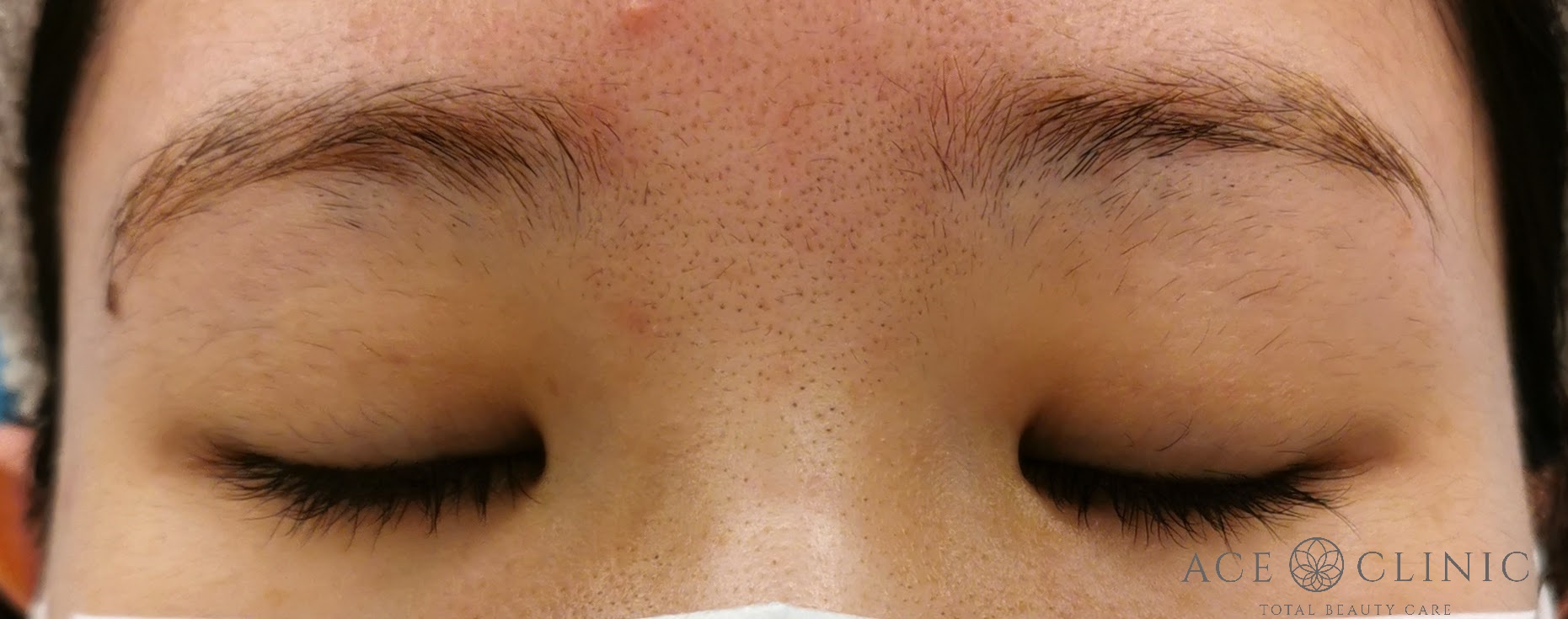 二重まぶた埋没法　症例　20代女性　施術後　閉瞼時　【エースクリニック】名古屋・大阪梅田