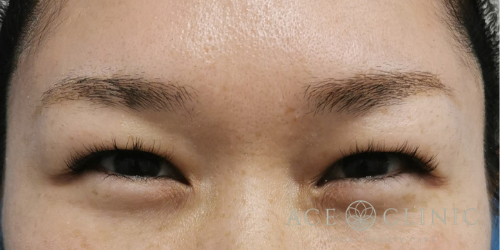 しわ取りボトックス注射_症例_エースクリニック名古屋 (5)