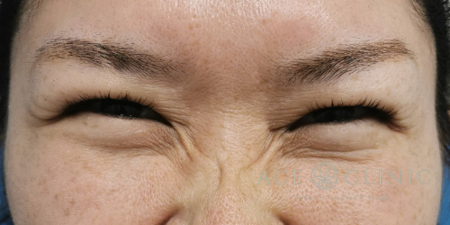 しわ取りボトックス注射_症例_エースクリニック名古屋 (5)