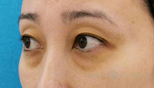 経結膜ハムラ法（裏ハムラ）　目の下のクマ治療　30代女性　【エースクリニック】名古屋院・大阪梅田院