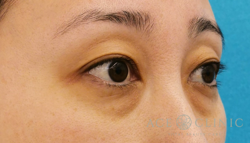 経結膜ハムラ法（裏ハムラ）　目の下のクマ治療　30代女性【エースクリニック】名古屋院・大阪梅田院