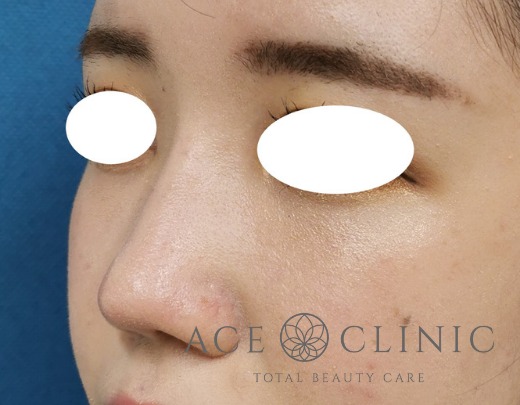 整鼻術【エースクリニック】名古屋院・大阪梅田院
