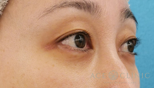 経結膜ハムラ法（裏ハムラ）　目の下のクマ治療　30代女性　術後【エースクリニック】名古屋院・大阪梅田院