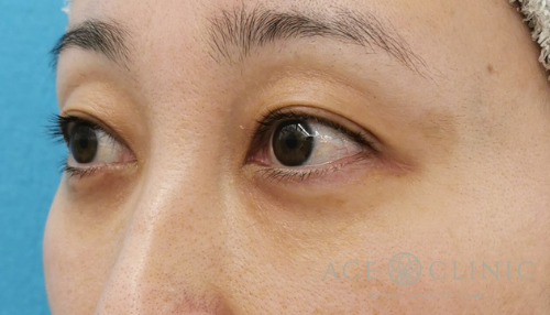 経結膜ハムラ法（裏ハムラ）　目の下のクマ治療　30代女性　術後【エースクリニック】名古屋院・大阪梅田院