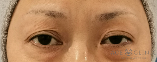 眼瞼下垂_眼瞼挙筋前転法【エースクリニック】名古屋・大阪梅田