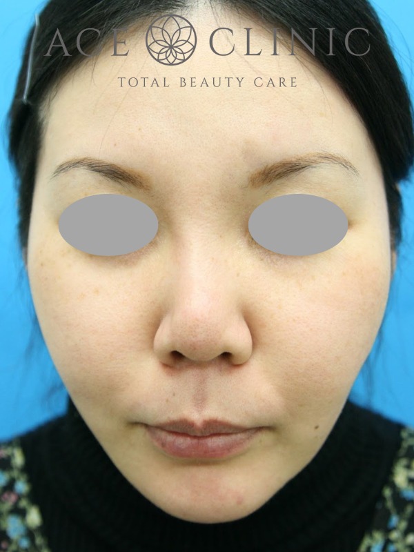 あごプロテーゼ挿入術｜症例2｜術後　正面｜エースクリニック大阪梅田HEPナビオ院