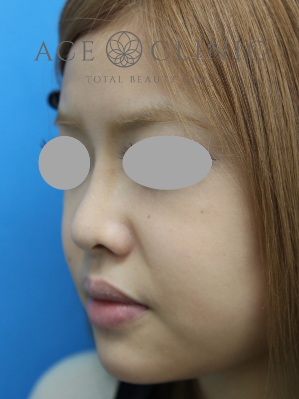 あごプロテーゼ挿入術|症例1|20代女性|術後 左斜め|エースクリニック大阪梅田HEPナビオ院