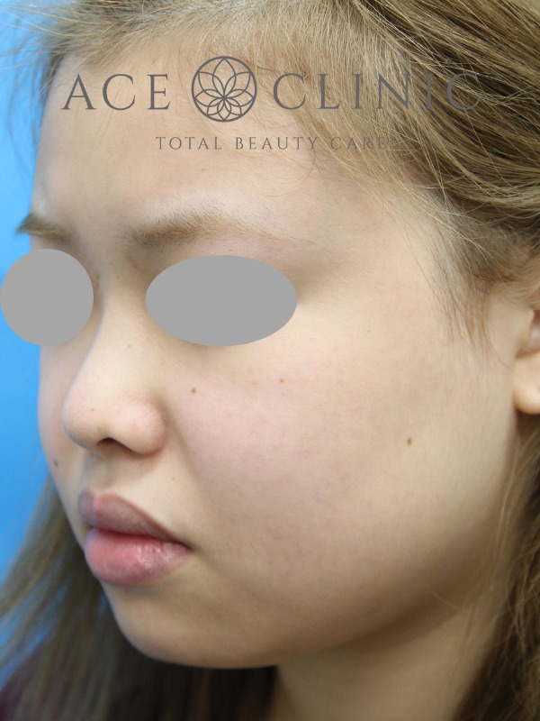 あごプロテーゼ挿入術|症例1|20代女性|術前 左斜め|エースクリニック大阪梅田HEPナビオ院