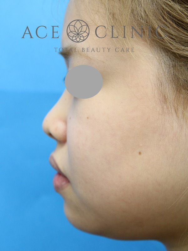 あごプロテーゼ挿入術|症例1|20代女性|術前 横|エースクリニック大阪梅田HEPナビオ院