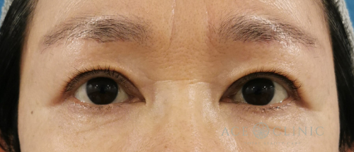 眼瞼下垂・まぶたのたるみ治療_眉毛下切開法症例_【エースクリニック】名古屋院・大阪梅田院 (1)