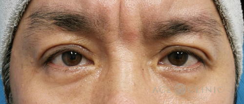 眼瞼下垂治療_眼瞼挙筋前転法症例_【エースクリニック】名古屋院・大阪梅田院 (1)