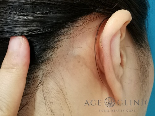 タトゥー除去_ピコレーザー治療_女性【エースクリニック】名古屋院・大阪梅田院 (1)