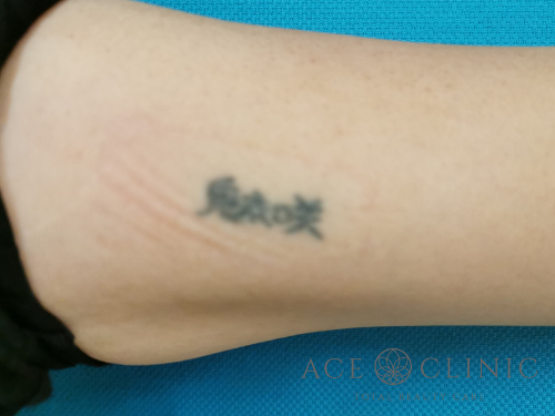 タトゥー除去_ピコレーザー治療_女性【エースクリニック】名古屋院・大阪梅田院 (2)