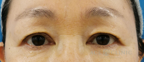 眼瞼下垂・まぶたのたるみ治療_眉毛下切開法症例_【エースクリニック】名古屋院・大阪梅田院
