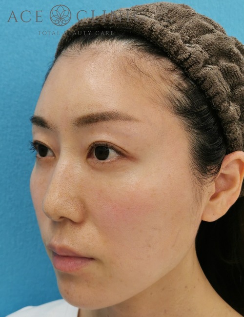 顔のリフトアップ・しわたるみ治療_ヒアルロン酸注入・ボトックス注射症例_【エースクリニック】名古屋院・大阪梅田院