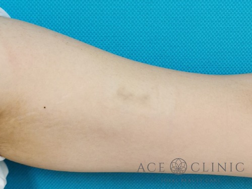 タトゥー除去_ピコレーザー治療_女性【エースクリニック】名古屋院・大阪梅田院 (3)