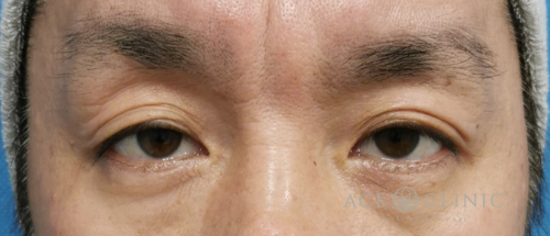 眼瞼下垂治療_眼瞼挙筋前転法症例_【エースクリニック】名古屋院・大阪梅田院