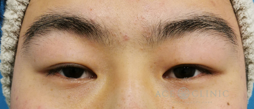眼瞼下垂治療_眼瞼挙筋前転法症例_【エースクリニック】名古屋院・大阪梅田院 (2)