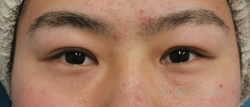 眼瞼下垂治療_眼瞼挙筋前転法症例_【エースクリニック】名古屋院・大阪梅田院 (3)