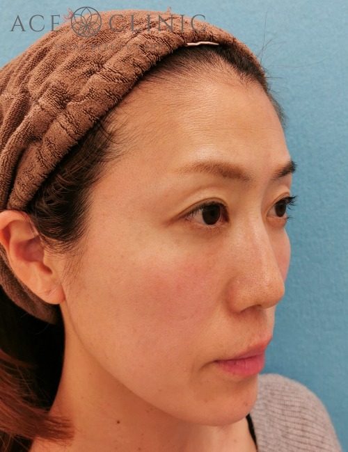 顔のリフトアップ・しわたるみ治療_ヒアルロン酸注入・ボトックス注射症例_【エースクリニック】名古屋院・大阪梅田院