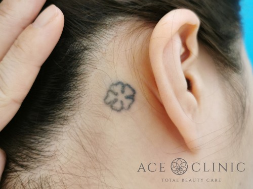 タトゥー除去_ピコレーザー治療_女性【エースクリニック】名古屋院・大阪梅田院