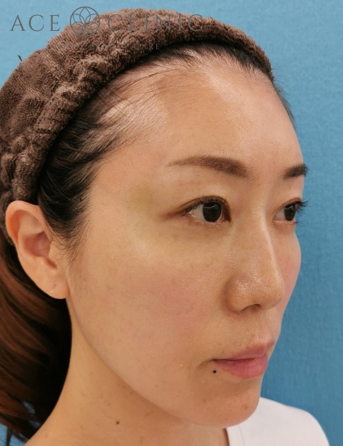 顔のリフトアップ・しわたるみ治療_ヒアルロン酸注入・ボトックス注射症例_【エースクリニック】名古屋院・大阪梅田院
