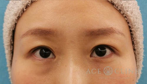 眼瞼下垂治療_眼瞼挙筋前転法症例_女性【エースクリニック】名古屋院・大阪梅田院 (3)