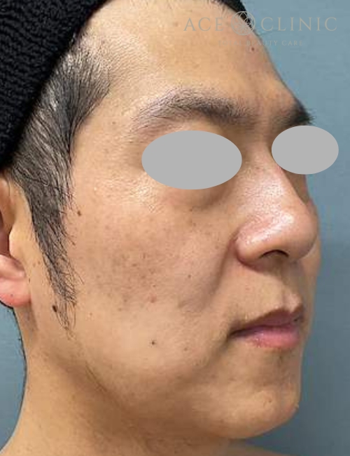 医療ハイフ｜症例1｜40代男性｜術後｜エースクリニック大阪梅田HEPナビオ院