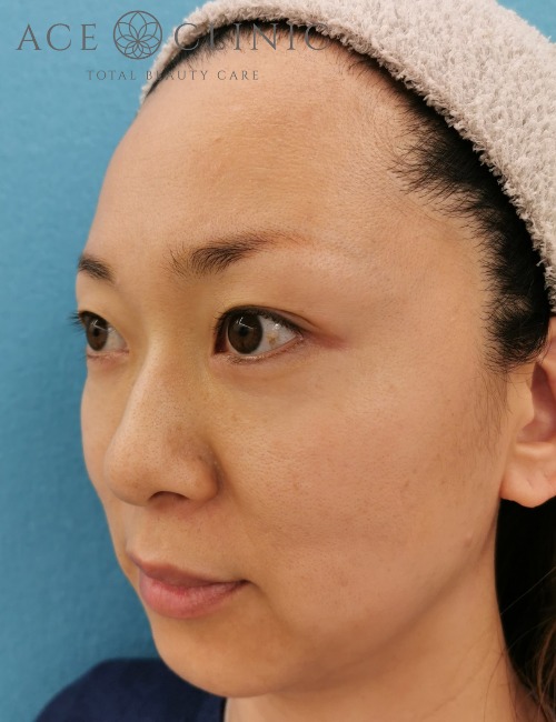 顔のリフトアップ・しわたるみ治療_ヒアルロン酸注入・ボトックス注射症例_【エースクリニック】名古屋院・大阪梅田院