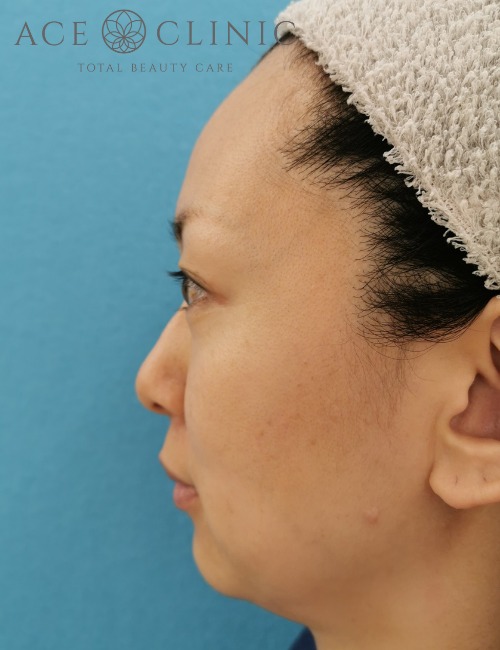 顔のリフトアップ・しわたるみ治療_ヒアルロン酸注入・ボトックス注射症例_【エースクリニック】名古屋院・大阪梅田院