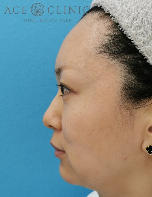 顔のリフトアップ・しわたるみ治療_ヒアルロン酸注入・ボトックス注射症例_【エースクリニック】名古屋院・大阪梅田院